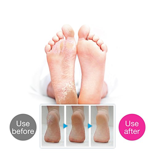 Hornhauthobel,Breett Hornhautfeile Harte Haut Entferner Mit Klinge Fußpflege Werkzeug - 7