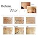 Abody 7Pcs Stainless Steel Facial Pimple Comedone Needle Acne Extractor Cleaner Blackhead & Blemish Kit with Black Bag