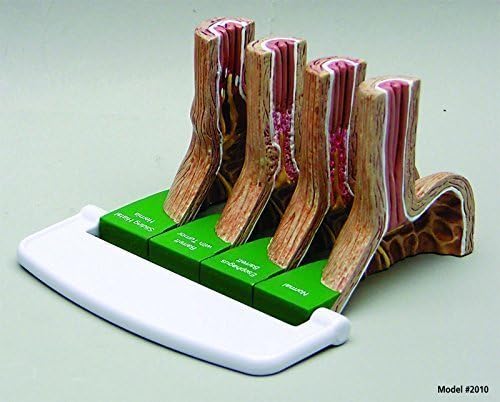 GERD Gastroesophageal Reflux Set of 4 Anatomical Model w Educational Key Card