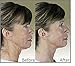 Deluxe DermaWand Anti-Aging System (UK Plug) - With 2 Essential Creams to REDUCE WRINKLES!