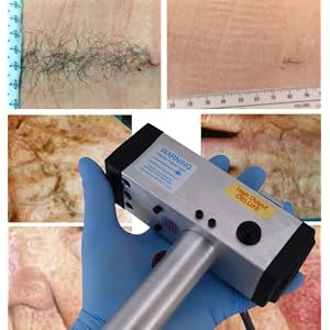 SPL800-EC professional intense pulsed light for tattoo removal, wrinkle reduction, age spots and more. - Image 3