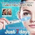 Blue Light Therapy Varicose Veins Treatment Pen Soft Acne Scar Blemish Wrinkle Removal