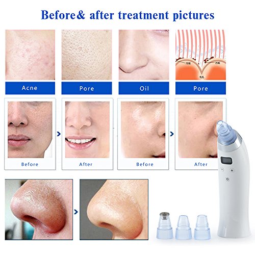 Beautystar poren sauger Elektro porenreiniger Schönheit Instrument an die Oberfläche der Haut reinigen Mitesser akne remover - 4