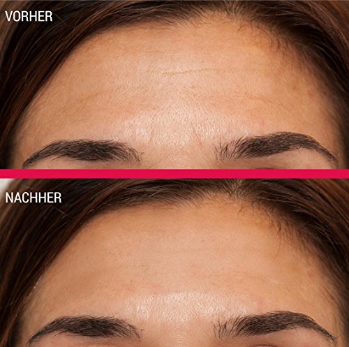 BEAUTYROLLER® – DAS ORIGINAL VON WALBERG® | Micro-Needling für frischen Teint | Anti-Aging-Tool zur Verbesserung des Hautbildes | Derma-Roller aus Chirurgenstahl (Hypoallergener Edelstah) | Handstück aus Makrolon® Polycarbonat (Premiumqualität von Bayer®) | Jetzt noch effektiver mit 30% dünneren Nadeln - 2