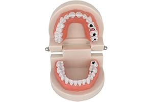 Decay Tooth Model, YOUYA Dental Caries Standard Teeth Teaching Model Study Tool Adult Disease Standard Typodont Demonstration Teeth Model for Kids Oral Care Teaching
