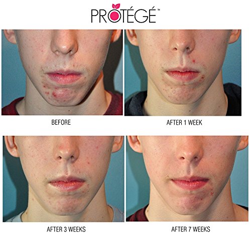 Natürliche Aknebehandlungscreme – X-ZIT – X Out Akne Behandlung für Erwachsene und Teenager + Bekommen Sie ein reines Gesicht + Kontrollieren Sie Pickelbildung auf natürliche Art mit dieser Akne Creme (60 ml) - 9