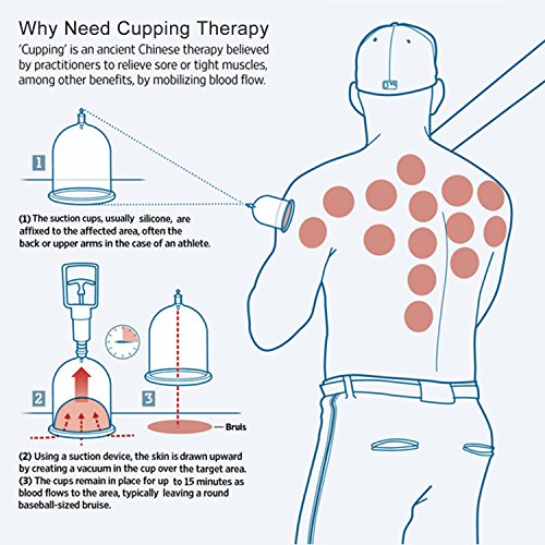 Chinesische Schröpfen Physiotherapie Set bei DigHealth, 12 Schröpfgläser mit Vakuumpumpe und Ventil, Naturheilkunde Selbstbehandlung Massage für Rückenschmerzen, Cellulite, Gesicht, Abnehmen, Bauch - 8