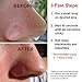 Blackhead Remover- Powerful Salicylic Acid Peel for Face – Blackhead Removal Dissolving Gel & Acne Spot Treatment for Teens, Men & Women – Made in USA by Concept Skin