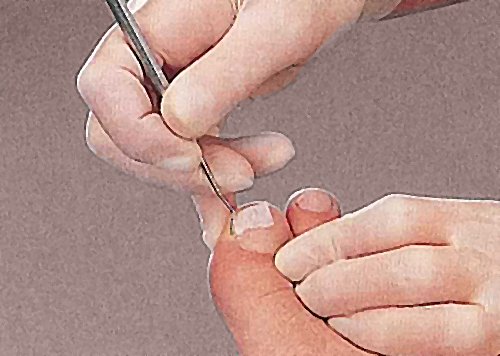 4x Nagelfalztamponade Copoline, Kosmetex Tamponade für Nägel-Nagelfalz, Tamponadebinde 1cm breit, 4x Tamponade - 2