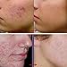 LuckyFine Acne Remove Anti-acne Scar Blemish Face Skin Care Treatment Aloe Vera Gel