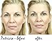 Dermawand - UK 220-240V 50 Hz UK PLUG - Derma Wand For Wrinkles | Puffy Eyes | Skin Tightening | Saggy Skin | Non-Surgical Face Lift | Blemishes | RF Treatment | Ships from the UK by Amazon