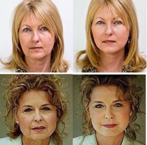 NEUE INSTANT FACELIFT und NECKLIFT Gesicht Hals LIFT KIT Bänder ANTI AGEING Streifen von Emmy preisgekrönte Make-up Künstler Art Harding (Helles Haar) - 4