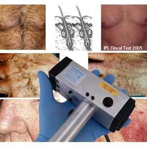 IPL-850aDX Intense Pulsed Light Photo Epilation System - Image 3