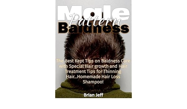 Male Pattern Baldness The Best Kept Tips On Baldness Cure With