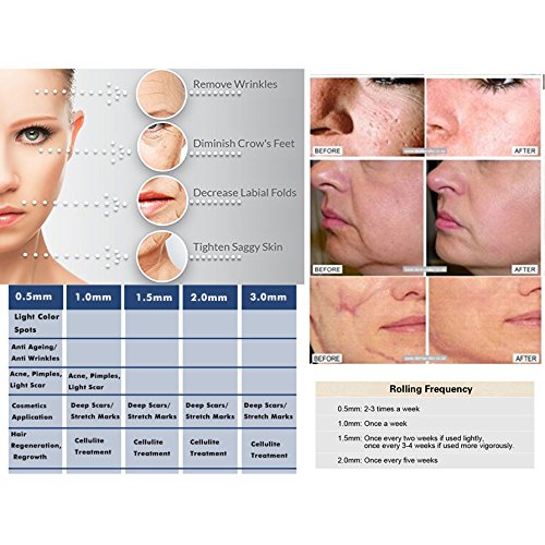 Hommii 4 in 1 Mikro Derma Roller Sterilisierte Titanium Nadeln Kit (0.5mm/180 Nadeln 1.0mm/600 Nadeln 1.5mm/1200 Nadeln) – Best Skin Roller Kit für Anti Ageing, Akne-Narben, Dehnungsstreifen, Falten, Augenbeutel , Körper, Gesicht, Haarausfall, Cellulite, Scalp -Schwarz Griff mit Rot - 6