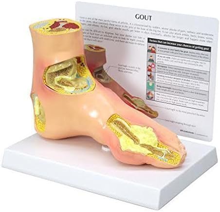 Foot Gout Anatomical Model w Educational Key Card