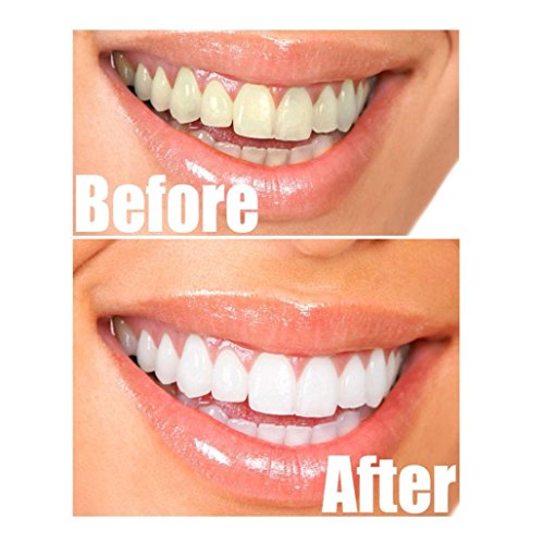 Holeider Natürliches Aktivkohle Zahnaufhellung mit Aktivkohle Pulver 30g ( activated charcoal teeth whitening ) - 2