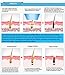Carer 3 Cartridges IPL Permanent Body Hair Removal Epilator + Acne Removal + Photorejuvenation, Light-Based , Home Use