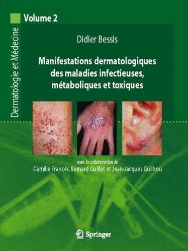 Download Manifestations dermatologiques et maladies infectieuses, métaboliques et toxiques. Download Manifestations dermatologiques et maladies infectieuses, métaboliques et toxiques.