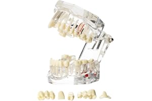 Windplusya Transparent Disease Teeth Model with Dental Implant Bridge, Dental Teach Crown Bridge Removable Model, Tooth Model for Patient and Dental Student Education. (Transparently)