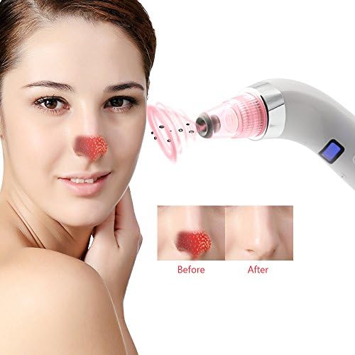 Blackhead remove ,Poren cleaner,Comedo suction beauty device,Acne Pimple Spot Remover Skin Cleansing Tool