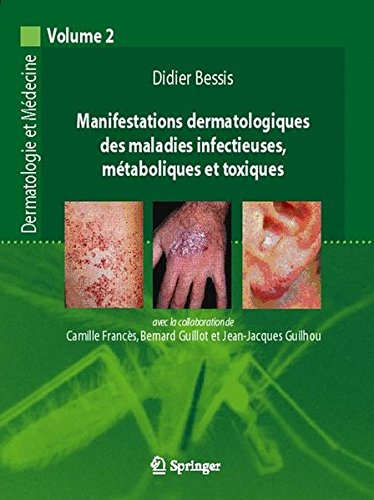 Download Manifestations dermatologiques et maladies infectieuses, métaboliques et toxiques. Download Manifestations dermatologiques et maladies infectieuses, métaboliques et toxiques.