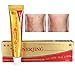 LuckyFine Details about Natrual Eczema, Psoriasis Dermatitis, Vitiligo, Skin rash, Minor Disease Cream