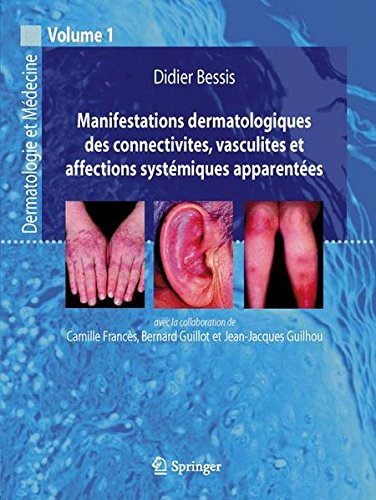 Manifestations Dermatologiques des Connectivites, Vasculites et Affections Systemiques Apparentees.