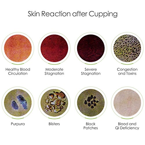 Chinesische Schröpfen Physiotherapie Set bei DigHealth, 12 Schröpfgläser mit Vakuumpumpe und Ventil, Naturheilkunde Selbstbehandlung Massage für Rückenschmerzen, Cellulite, Gesicht, Abnehmen, Bauch - 9