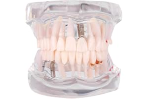 Cocoarm Zahnpflege Modell Abnehmbare Zahnmodell Arzt Demo Implant Zahnarzt Lehr Studie Modell Transparent Lehrwerkzeug für Zahnarztdemonstration