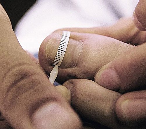 Erkodent Onyclip, Nagelkorrektur, Spange für jede Nagelform, für die Nagelfalzbehandlung, Einführungspackung - 2