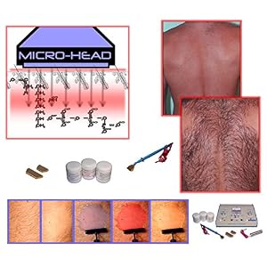 Aavexx Micro 1000 Mikrolyse für Genen Therapie für dauerhafte Haarentfernung - Image 2