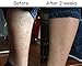 SR Lotion, Excellent Ichthyosis Treatment Cream, Outstanding Results in 2 Weeks
