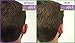 Otostick - TWIN PACK - Instant Correction for Prominent Ears