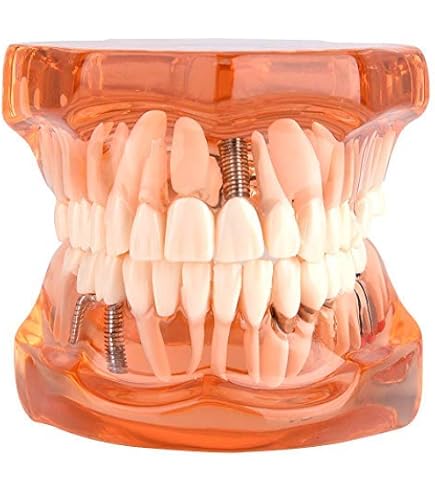 Modelo De Ortodoncia Dental Tipodonte/modelo De Restauración Dental De Modelo De Restauración De Prótesis 303948498626