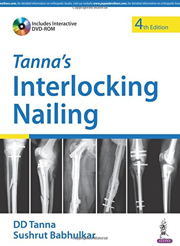 Tanna’s Interlocking Nailing