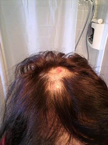 A Hairstylist S Approach To Winning The Head Lice War What