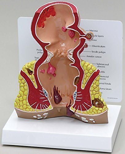 Rectum Colorectal Anatomical Model w Educational Key Card