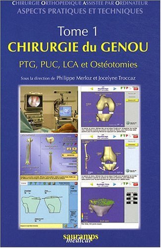 Chirurgie orthopédique assistée par ordinateur : Aspects pratiques et techniques Tome 1, Chirurgie du genou PTG, PUC, LCA et ostéotomies