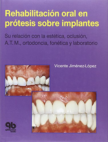 Libro gratis Rehabilitacion oral en protesis sobre implantes PDF