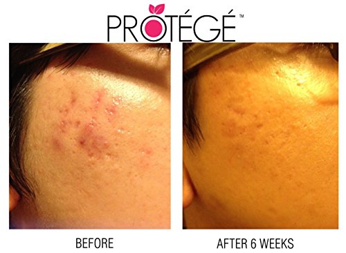 Narbengel – FLAWless – Natürliche Schadenbehebungskur + Für Narben und Wulstnarben (Keloide) + Aknenarben + Operationsnarben + Reduziert Rötungen & Kupferrosen (Rosazea) & Besenreiser + konzentrierte Formel (30ml) - 9