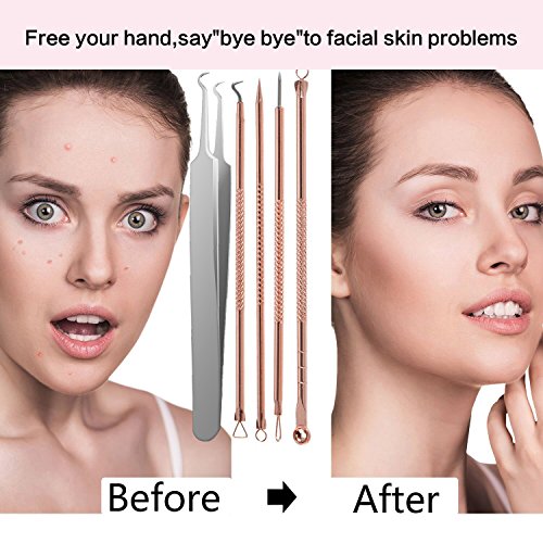 Cookey Blackhead Remover Kit, Comedone Extractor Tool, Anti-mikrobielle Doppelseitige 4 Stücke, Behandlung für Verunstaltung, Whitehead Popping, Zit Entfernen für Risiko Freie Nase (Golden) - 7