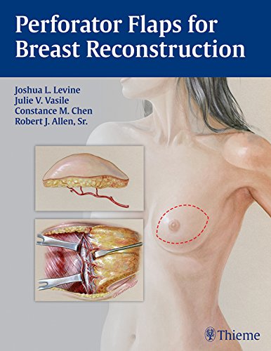 Perforator Flaps for Breast Reconstruction (English Edition)