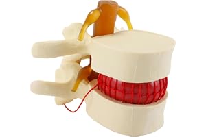 Orivin Anatomisk ländkotsmodell - 1,5X mänsklig ländkotsmodell för diskbråck, demonstrationsmodell för diskbråck
