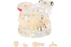 Annhua Disease Teeth Model Transparent Dental Model with Removable Teeth, Resin Pathological Teeth Model with Adjustable Angle, Teaching Teeth Model for Dental Students, Dentist, and Kids