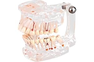 Walfront Modell mit abnehmbaren Zähnen, transparent, Implantat, Disease, Unterricht, Standardzähne, Modell pathologische Demonstration