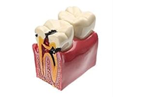 Dental Caries Tooth Model, YOUYA DENTAL Decay Teeth Comparative Study Model 6 Times Caries Tooth Teaching Tools