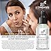 Art Naturals® Anti Acne Serum Treatment 30ml- Dermatologist Tested Product, Made with Revolutionary Evermat® & Organic Ingredients to Help Control & Get Rid of Acne - Best Pore Minimizer -For all Ages