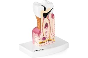 PHYSA WELLNESS & LIFESTYLE Physa Maquette Anatomique Dentition Humaine Modèle Anatomie Dents Molaire Malade Carie PHY-TM-1 (2:1, Précision Médicale, Plastique)