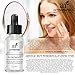 Art Naturals® Anti Acne Serum Treatment 30ml- Dermatologist Tested Product, Made with Revolutionary Evermat® & Organic Ingredients to Help Control & Get Rid of Acne - Best Pore Minimizer -For all Ages